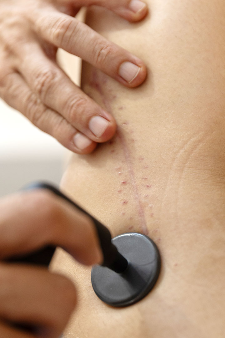 Regeneración de tejidos y cicatrices con INDIBA en Fisioterapia Idun